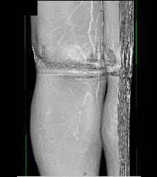 Bakers Cyst - CTisus CT Scan