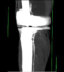 Bakers Cyst - CTisus CT Scan