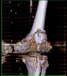 Bakers Cyst - CTisus CT Scan