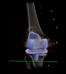 Bakers Cyst - CTisus CT Scan