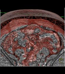 DIEP Flap Planning - CTisus CT Scan