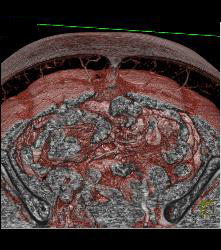 DIEP Flap Planning - CTisus CT Scan