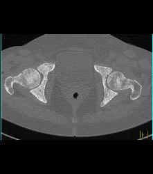 Metastatic Breast Cancer - CTisus CT Scan