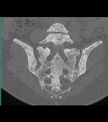 Metastatic Breast Cancer - CTisus CT Scan