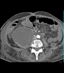 Psoas Abscess and IVC Clot - CTisus CT Scan