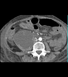 Psoas Abscess and IVC Clot - CTisus CT Scan