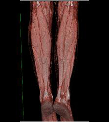 Normal Calf Muscles - CTisus CT Scan