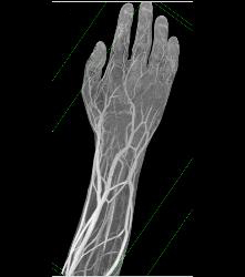 Cellulitis With Normal Vascular Arcade- in Multiple Displays - CTisus CT Scan