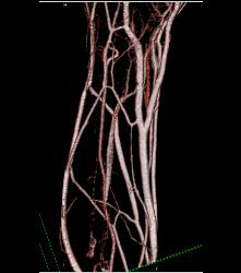 Cellulitis With Normal Vascular Arcade- in Multiple Displays - CTisus CT Scan