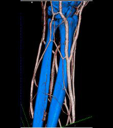 Cellulitis With Normal Vascular Arcade- in Multiple Displays - CTisus CT Scan