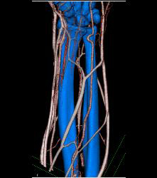 Cellulitis With Normal Vascular Arcade- in Multiple Displays - CTisus CT Scan