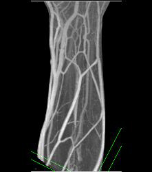 Cellulitis With Normal Vascular Arcade- in Multiple Displays - CTisus CT Scan