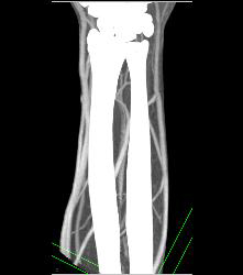 Cellulitis With Normal Vascular Arcade- in Multiple Displays - CTisus CT Scan