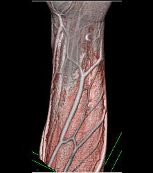 Cellulitis With Normal Vascular Arcade- in Multiple Displays - CTisus CT Scan