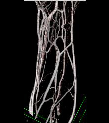 Cellulitis With Normal Vascular Arcade- in Multiple Displays - CTisus CT Scan