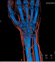 Cellulitis With Normal Vascular Arcade- in Multiple Displays - CTisus CT Scan