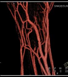 Cellulitis With Normal Vascular Arcade- in Multiple Displays - CTisus CT Scan