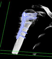 Hardware for Repair of Humerus Fracture - CTisus CT Scan