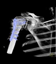 Hardware for Repair of Humerus Fracture - CTisus CT Scan