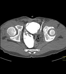 Exstrophy of the Bladder With Bladder Leak - CTisus CT Scan