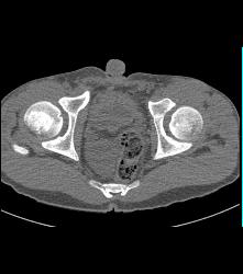 Exstrophy of the Bladder With Bladder Leak - Musculoskeletal Case ...