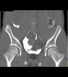 Exstrophy of the Bladder With Bladder Leak - CTisus CT Scan