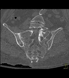 Sacral Fracture - CTisus CT Scan