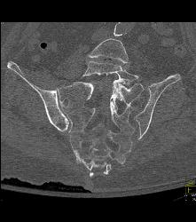 Sacral Fracture - CTisus CT Scan