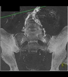 Sacral Fracture - CTisus CT Scan