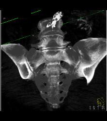 Sacral Fracture - CTisus CT Scan