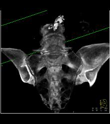 Sacral Fracture - CTisus CT Scan