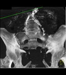 Sacral Fracture - CTisus CT Scan