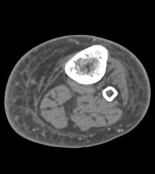 Ulceration of the Calf - CTisus CT Scan