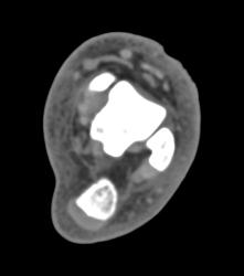 Ulceration of the Calf - CTisus CT Scan