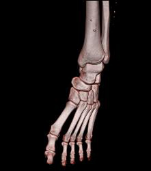 Ulceration of the Calf - CTisus CT Scan