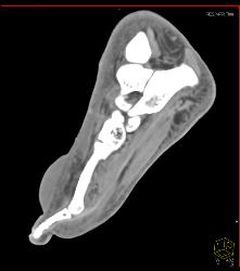 Blister on Dorsum of Foot - CTisus CT Scan