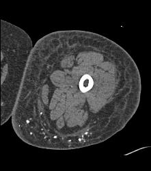 Soft Tissue Calcification - CTisus CT Scan