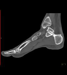 Tarsal Coalition- Fibrous - CTisus CT Scan