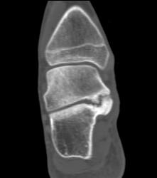 Tarsal Coalition- Fibrous - CTisus CT Scan