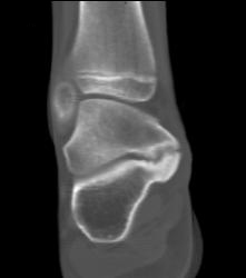 Tarsal Coalition- Fibrous - CTisus CT Scan