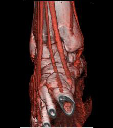 Tarsal Coalition- Fibrous - CTisus CT Scan