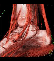 Tarsal Coalition- Fibrous - CTisus CT Scan