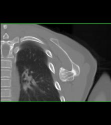 Exostosis Off Scapula - CTisus CT Scan