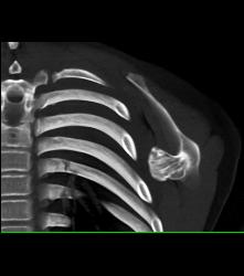 Exostosis Off Scapula - CTisus CT Scan