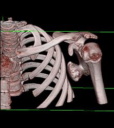 Exostosis Off Scapula - CTisus CT Scan