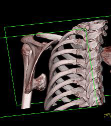 Exostosis Off Scapula - CTisus CT Scan