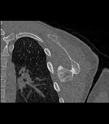 Exostosis Off Scapula - CTisus CT Scan