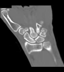 Scaphoid Fracture - CTisus CT Scan