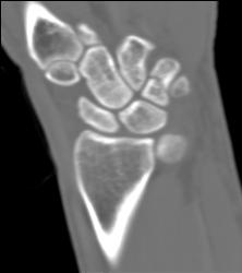 Scaphoid Fracture - CTisus CT Scan