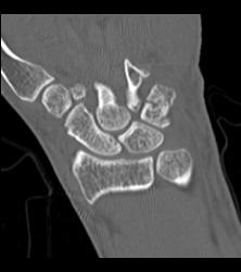 Fracture/dislocation in 3D - CTisus CT Scan